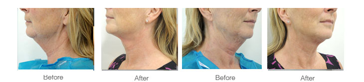 neck lift before and after photographs after laser surgical neck lift performed at Aset hOSPITAL
